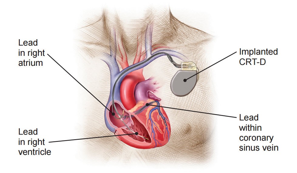 CRT-D device